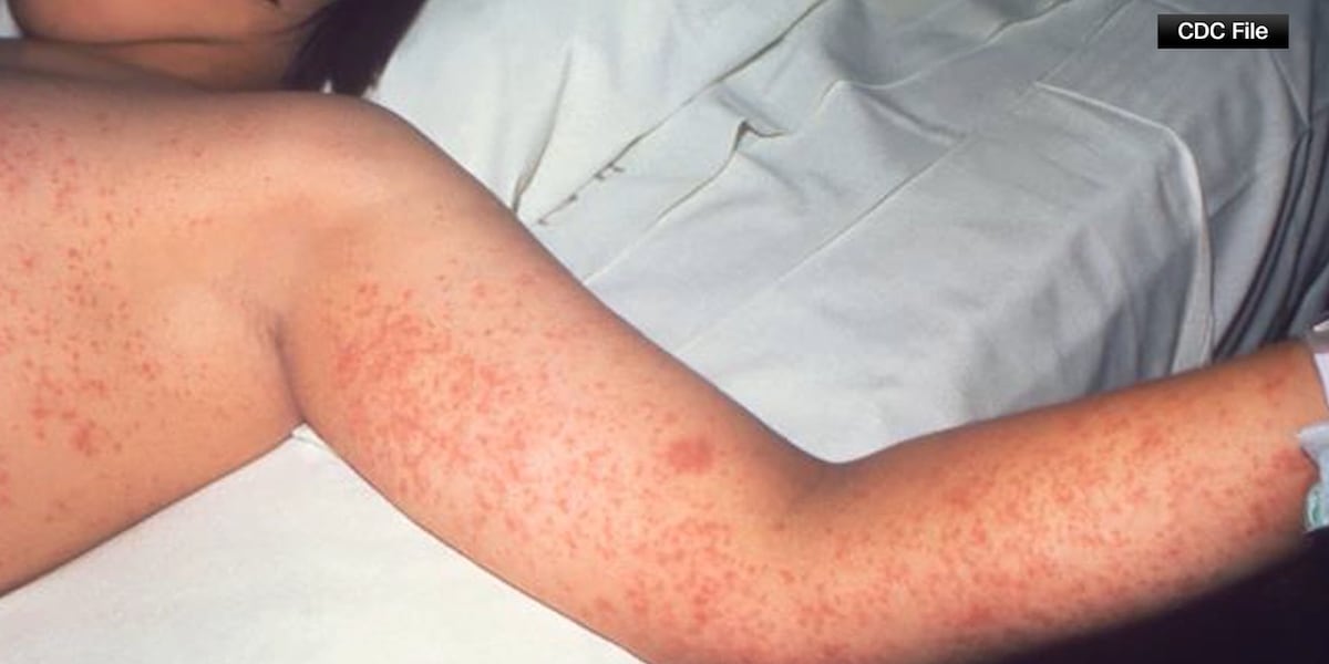 Measles confirmed in Colorado Springs, public asked to watch for symptoms - KKTV